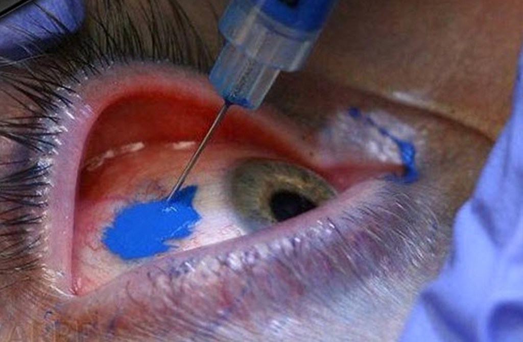 Proces tetovania oka 