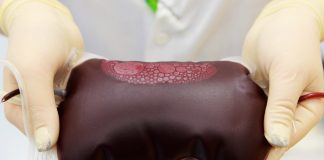 Kontroverzný startup si účtuje za transfúziu mladej krvi až $8,000. Deklaruje, že vďaka tomu dokážu zastaviť proces starnutia