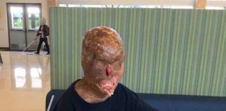 Slepému tínedžerovi, ktorého telo zničil oheň, ľudia vyzbierali státisíce, aby konečne uvidel svoju rodinu