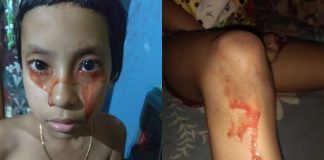 Dievčatko trpí ochorením hematohydróza, na ktoré doposiaľ nebol vynájdený liek – plače a potí krv…